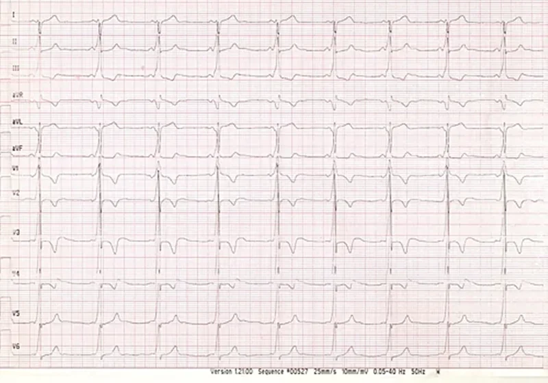 Student ECG:No-1