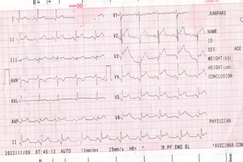 Student ECG:No-2