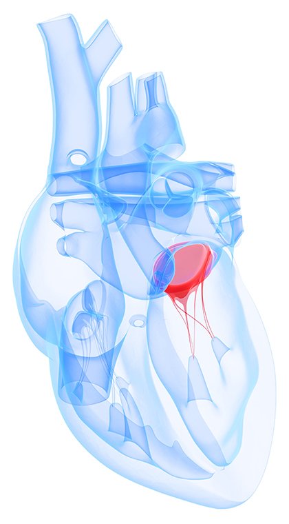 پرولاپس دریچه میترال